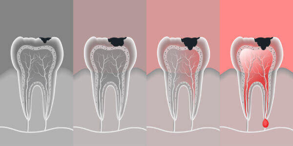 Tooth Cavities